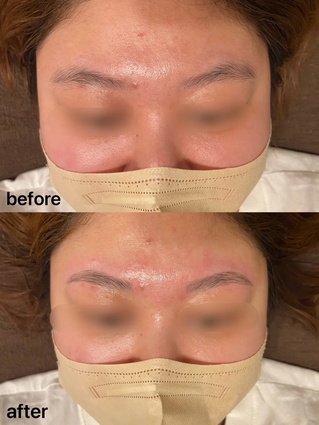 【ハリウッドブロウリフト（HBL)/ビフォーアフター】