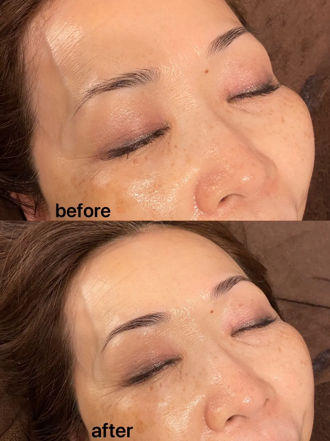 【ハリウッドブロウリフト（HBL)/ビフォーアフター】